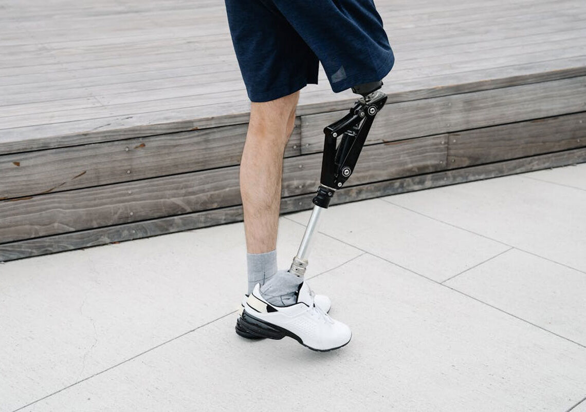 amputation compensation