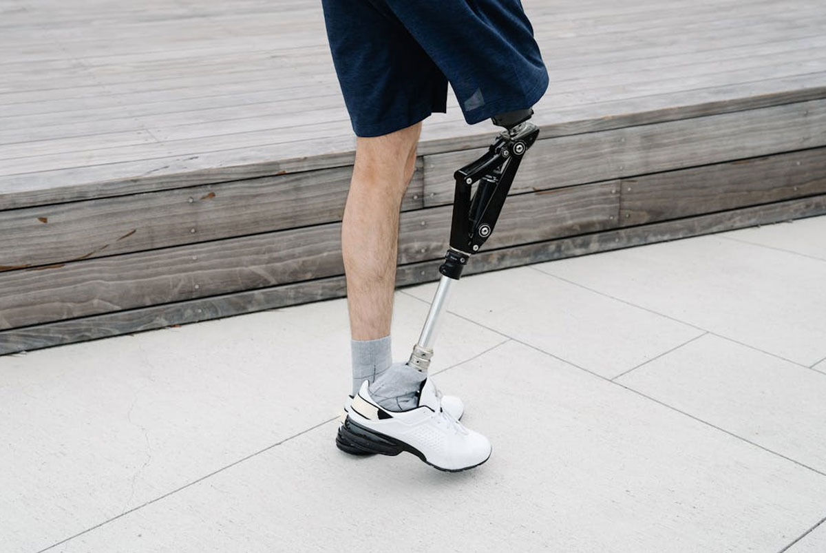 amputation compensation