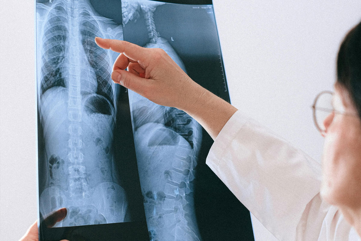 spinal injury compensation